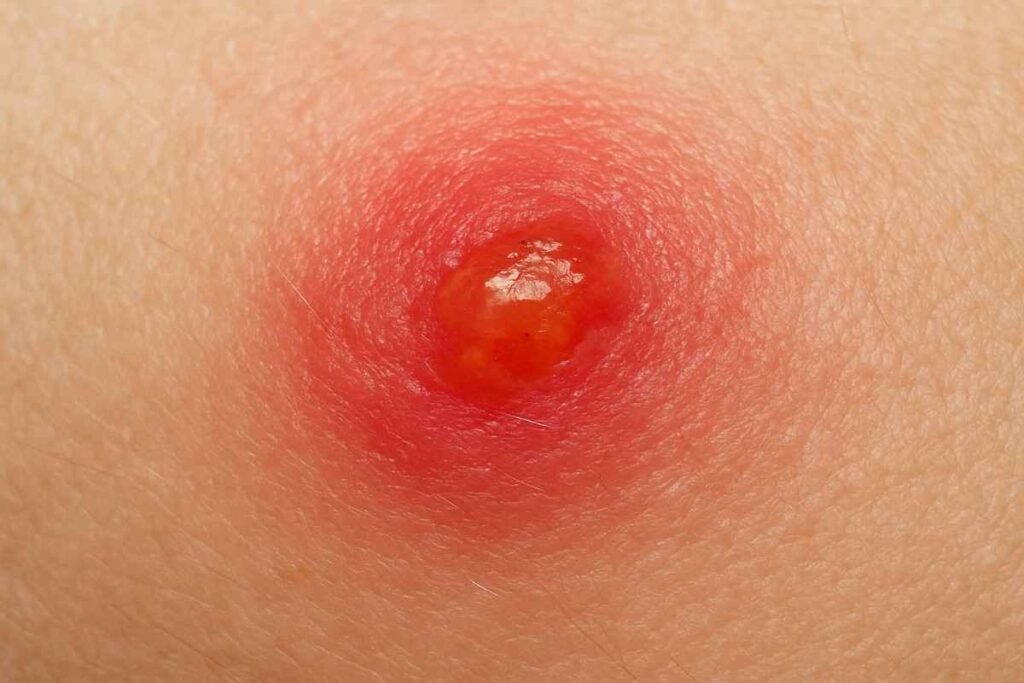 A Comprehensive Guide to Dog Bites: Prevention, First Aid, and Legal Steps for the U.S. 3 dog bite wound